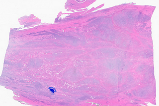 Crystal Storing Histiocytosis with Associated Plasma Cell Neoplasm