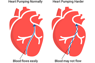 Hypertension: Understanding the Silent Killer