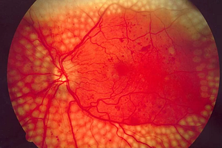 A Promising Study Revealing Co-Relation Between Vitamin C & Retinopathy.