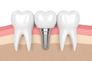 Transforming Smiles: The Gateway to Confidence with Dental Implants in Miami