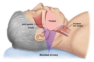 Sleep Apnea — Causes, Symptoms and Diagnosis