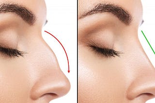 Liquid rhinoplasty- Non surgical procedure
