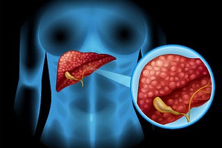 Health Conditions Linked to Alcoholic Liver Damage