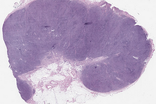 Multicentric Idiopathic Mixed Plasma Cell Castleman Disease
