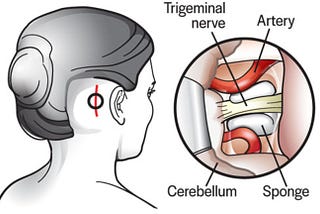 Understanding Microvascular Decompression Surgery