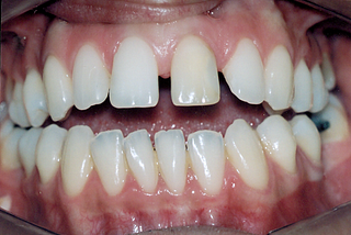 Nem trocou os dentes, precisa de aparelho?