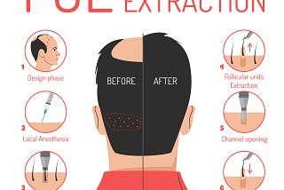 FUE Hair Transplant in Turkey: The Future of Hair Restoration