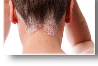 Suffering from psoriasis?There are several home remedies