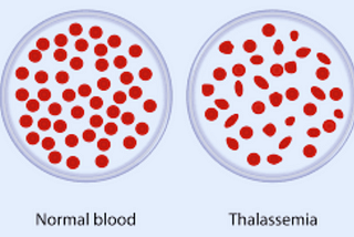 What is Sickle Beta Thalassemia (5 Best Points)