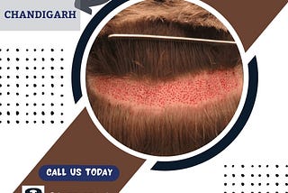 Hair Transplant Doctor in Chandigarh