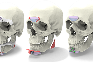 Three skulls showing locations of bone grafting/shaving for gender affirming facial surgeries