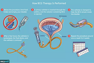 BCG Treatments — Bladder Cancer Awareness Month