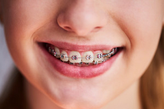 clean braces tips