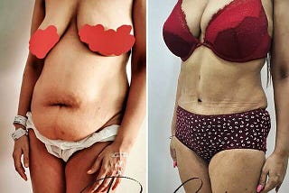 What to Expect Before and After the Liposuction Procedure