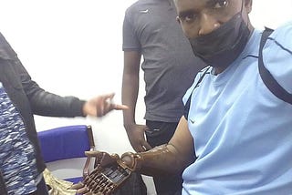 Regaining Independence With 3D-Printed Prosthesis: John’s Story
