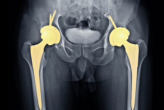 Joint Implants Create Some Serious Bad Blood