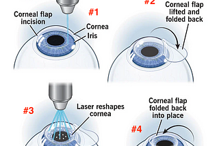 My LASIK Journey