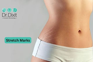 Stretch Marks Treatment in Bangalore