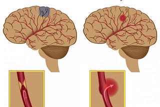 Obat Stroke Kedokteran