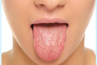 woman’s mouth with dry tongue cottonmouth