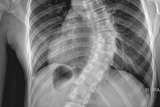 My Scoliosis Story — From a Pillow Inventor