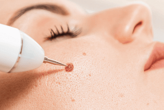 Dermatologist removing mole from girls face