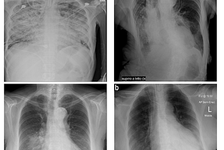 High-Accuracy Covid 19 Prediction from Chest X-Ray Images using Pre-Trained Convolutional Neural…