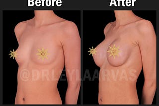 Breast Augmentation: Enhance Your Confidence and Beauty