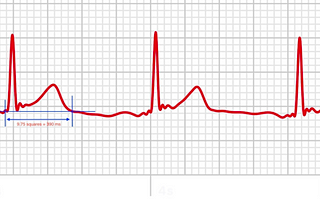 How to read your QT Interval