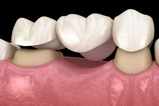 fill gaps between teeth with dental bridges in keller — abc family dental