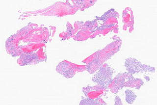 Anaplastic Variant of DLBCL with TP53 mutation