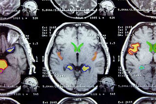 A Step-by-Step Case Study on Brain MRI Segmentation from Kaggle