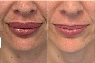 Case Study: Dissolving Lip Filler
