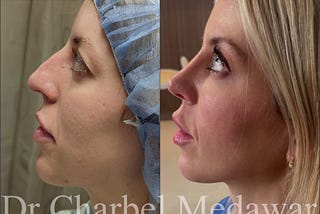 Dr Charbel Medawar Facial Beautification heidi Bitton Before After Plastic Surgery Profile