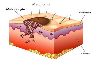 Is it Melanoma? Knowing These 5 Things Could Save a Life