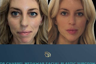 Dr Charbel Medawar Shows his Jawline Technique Transformative results