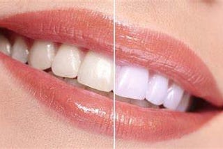 Why Don’t Teeth Whitening Strips Work? Answers from Professionals