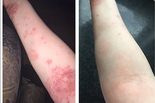 How Long Did Psoriasis Biologics Take to See Visible Results?
