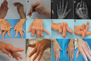 Why is it difficult to design a hand tremor dampening device?
