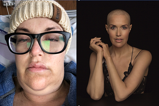 What To Expect From a Bone Marrow Transplant