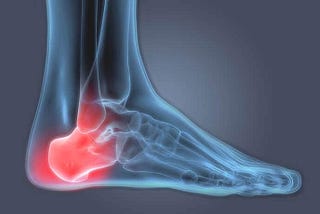 Heel Spur — Causes and Treatments