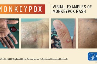 Monkeypox — a global health issue after COVID-19