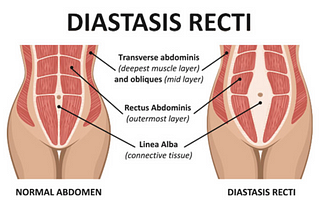 Journey Back to a Six-Pack (Diastasis Recti and Physical Therapy)