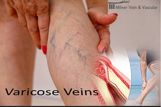 Best Varicose Vein Clinic in Lithonia, USA