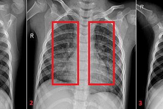 X-ray of a patient with covid pneumonia (Image 1 and 2) and a healthy patient without the presence of pneumonia (Image 3)