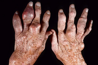 Crystal Hands: Understanding Gout and CPPD