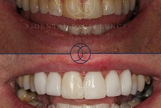 Composite Bonding Treatment