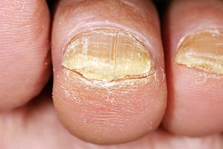 Toe Nail Fungus — I sure hope not!