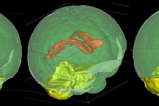 An image of the baby brain with cerebellum and ventricles highlighted to compare the sizes in relation to the entire brain.