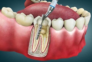 Root Canal Therapy Side Effects: What No One Tells You